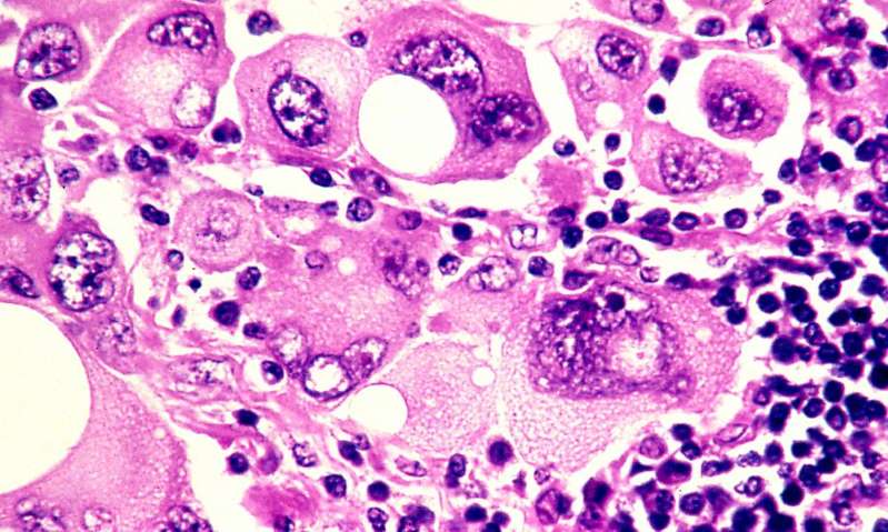 Faecal transplants