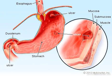 peptic ulcer